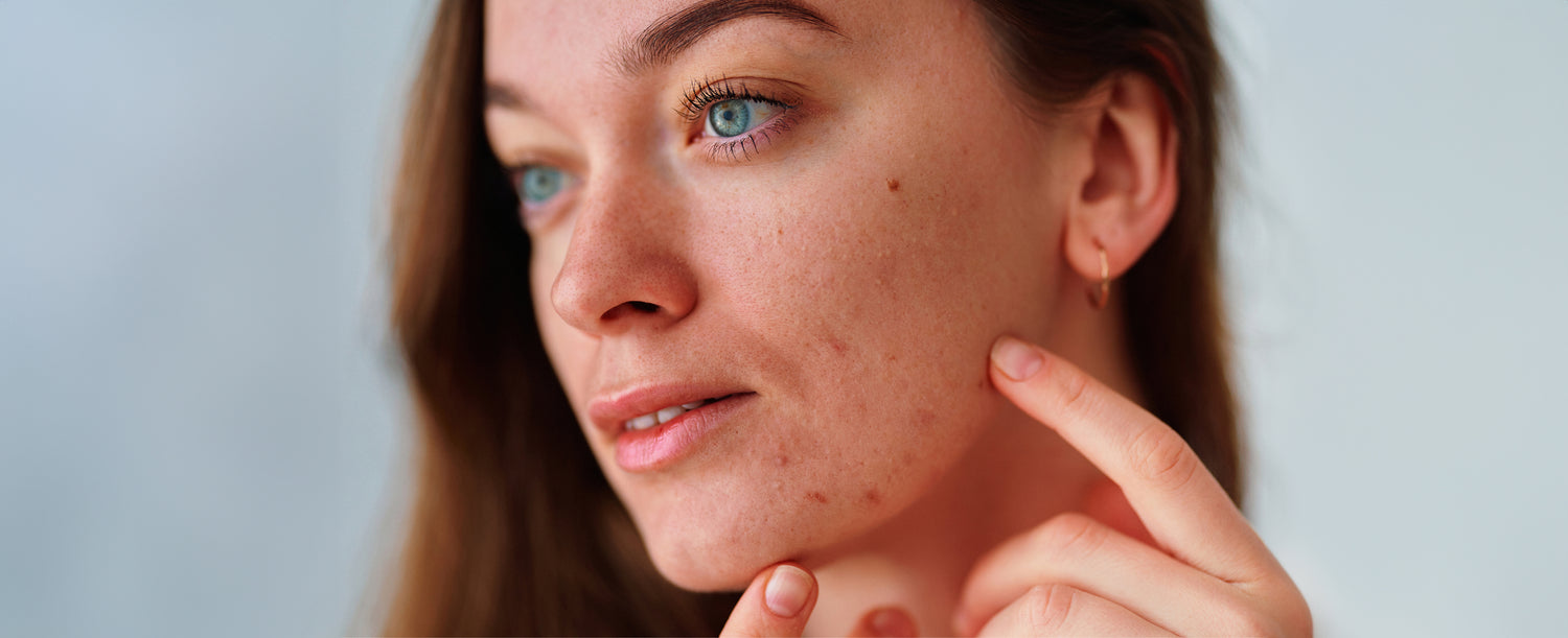 The Sensitive Skin Epidemic