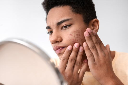 Skincare For Teens With Acne