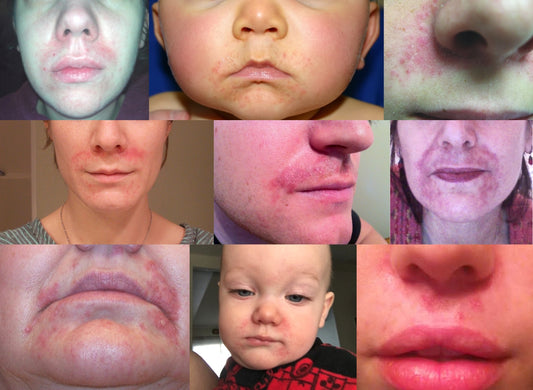 Six Steps For Healing Perioral Dermatitis